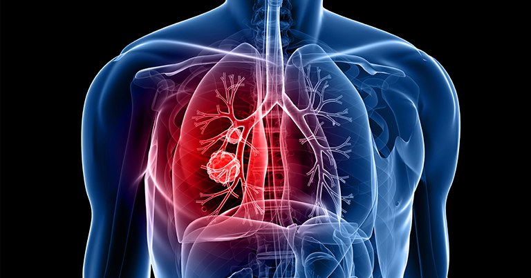 ХОЗЛ: хвороба, про яку ви могли не знати, але відчуваєте щоранку